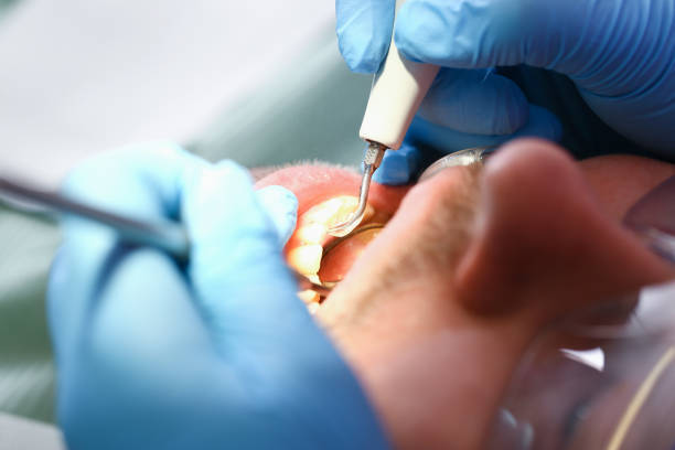 Best Emergency Dentist for Lost Fillings or Crowns in Cedar Hill, MO